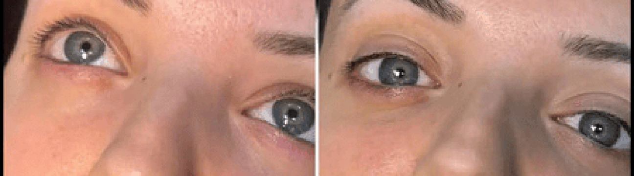 Dermal Fillers